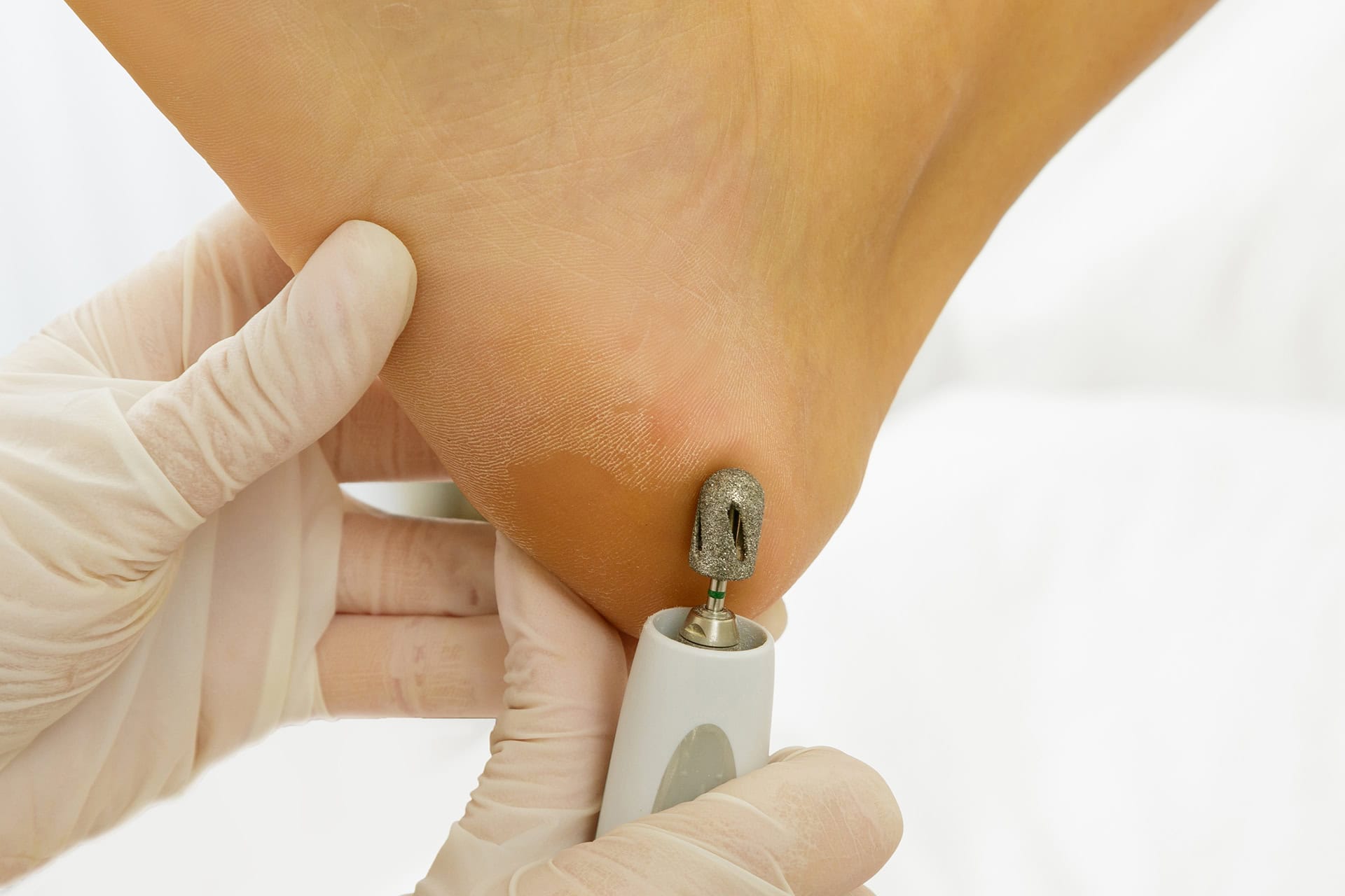 Dornwarze entfernen – aber richtig: Warum professionelle Behandlung entscheidend ist